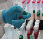 Northern Ireland TB rates surpass 12-year high
