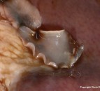 Fluke-mapping research has the potential to revolutionise treatment